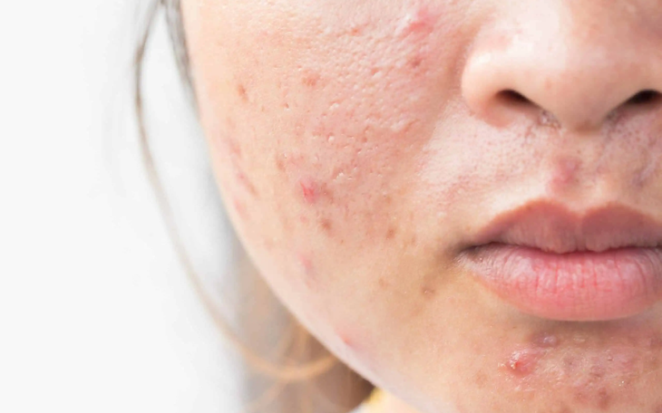 Cách ngăn ngừa mụn trứng cá trong kỳ kinh nguyệt - Ảnh 2.
