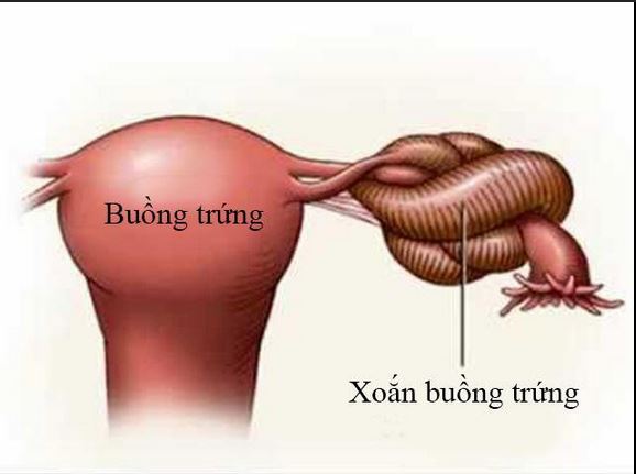 Cảnh Giác Về Xoắn U Nang Buồng Trứng: Triệu Chứng và Cách Điều Trị