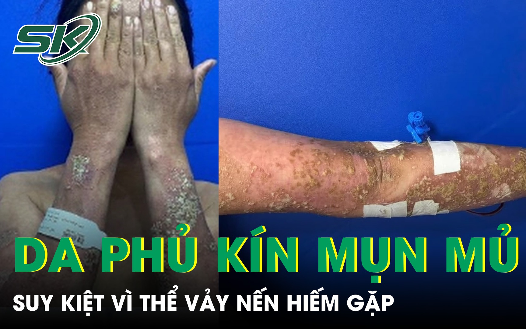 Làm Gì Khi Bị Vảy Nến: Nguyên Nhân và Cảnh Báo Khẩn Cấp