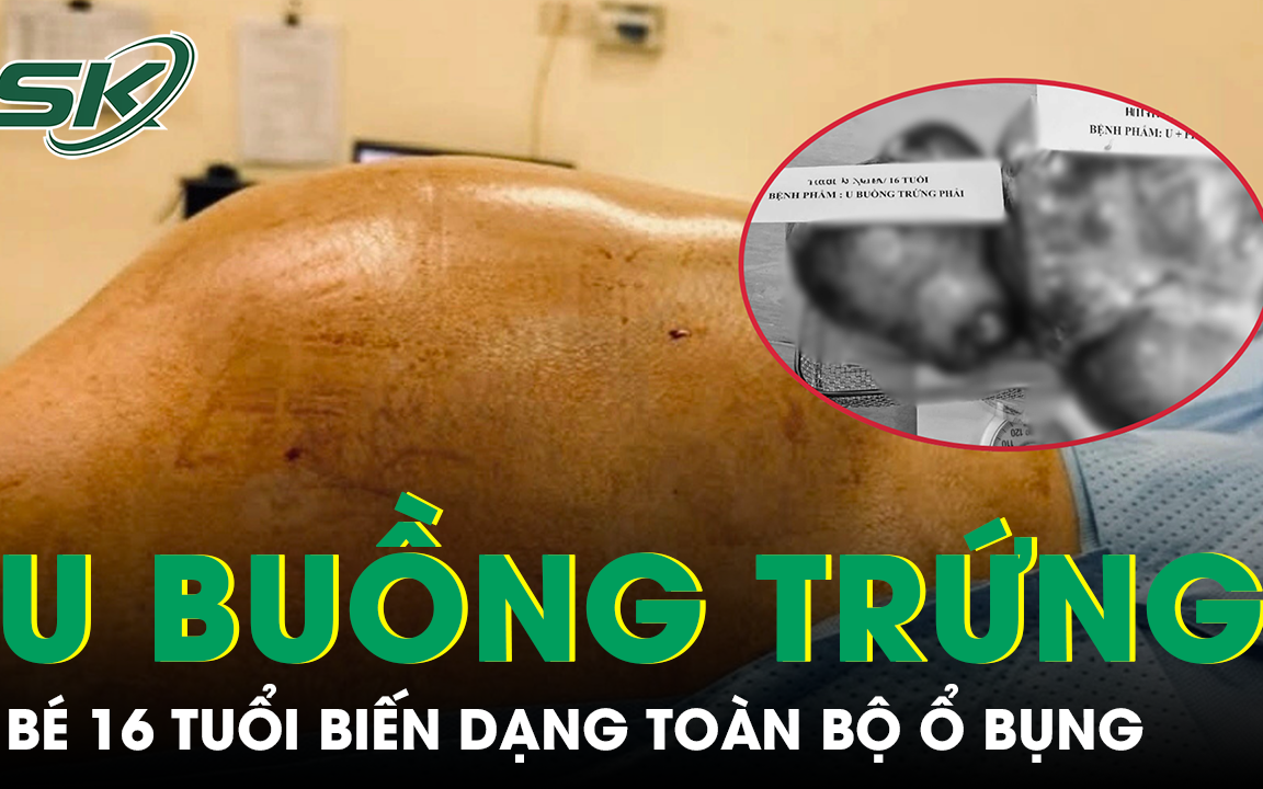Những Dấu Hiệu Cảnh Giác Khi Trẻ Có Khối U Buồng Trứng