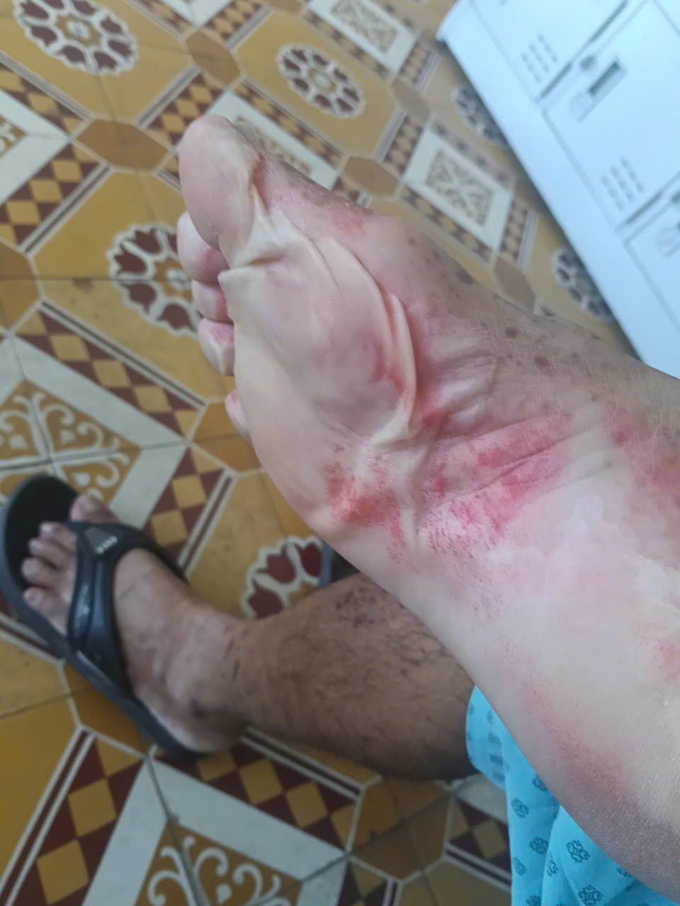 Cảnh Báo Dị Ứng Nghiêm Trọng Từ Thuốc Nhỏ Mắt: Trường Hợp Của Một Bệnh Nhân
