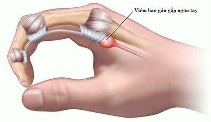 Cảnh Giác Với Viêm Gân Gấp Ngón Tay: Dấu Hiệu Và Nguyên Nhân Cần Biết