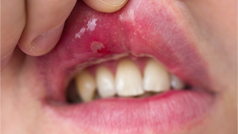 Chăm sóc sức khỏe răng miệng cho bệnh nhân Lupus ban đỏ Chăm sóc sức khỏe răng miệng cho bệnh nhân Lupus ban đỏ