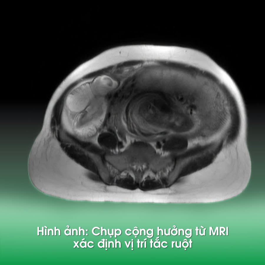 Cuộc Phẫu Thuật Đặc Biệt Giúp Thai Phụ 35 Tuần Vượt Qua Tình Trạng Tắc Ruột