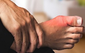Hướng Dẫn Chạy Bộ An Toàn Cho Người Bị Gout