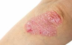 Tìm Hiểu Về Xét Nghiệm ctDNA Trong Điều Trị Ung Thư Đại Tràng