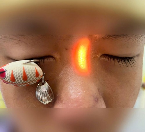Tai Nạn Mắt Ở Trẻ: Cảnh Giác Để Bảo Vệ Thị Lực
