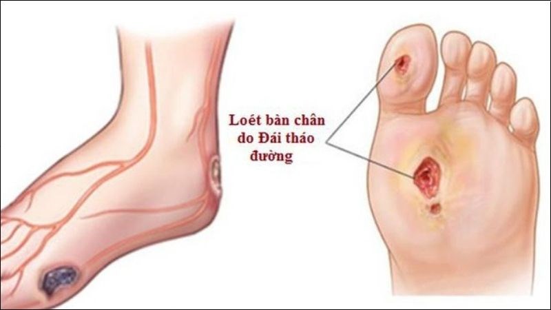 Những Dấu Hiệu Cảnh Báo Tổn Thương Thần Kinh Ở Người Bệnh Đái Tháo Đường