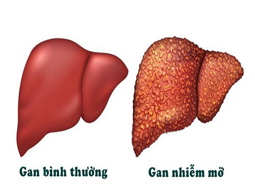 gan-nhiem-mo-la-gi-1-1785907312848-1785907313440442182680 Các xét nghiệm cần làm để kiểm tra, đánh giá mức độ gan nhiễm mỡ- Ảnh 1.