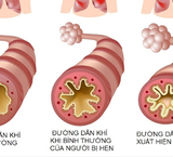 Cách Nhận Biết Khi Nào Cần Đưa Trẻ Đi Cấp Cứu Sau Khi Bị Sặc Nước