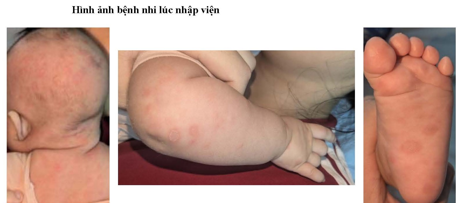 Bé gái 2 tháng tuổi mắc giang mai, nhầm sang viêm da cơ địa- Ảnh 1.