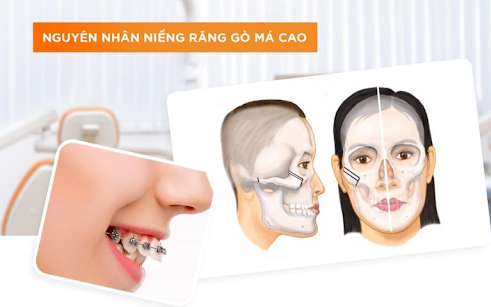 Giải Quyết Hiệu Quả Vấn Đề Hóp Má Khi Niềng Răng