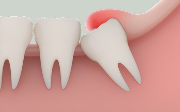Nhổ răng bằng chỉ, bé trai 7 tuổi xẹp phổi suýt tử vong- Ảnh 2.