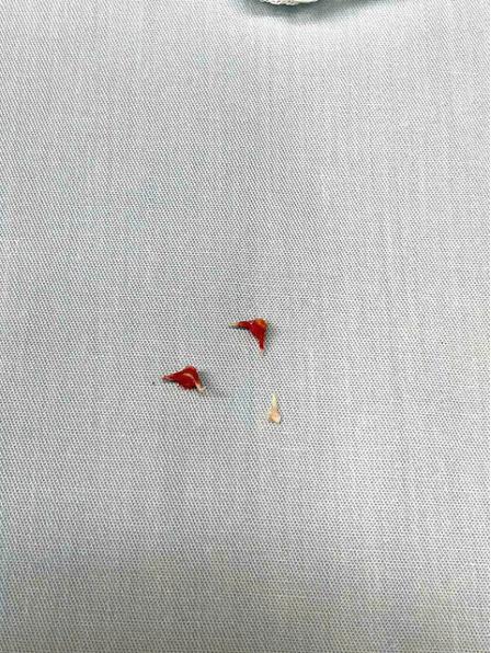 Lấy 3 mảnh xương lươn trong phế quản cho bé trai 7 tháng tuổi- Ảnh 1.