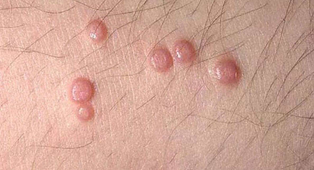 Con đường lây truyền mụn cóc sinh dục - Ảnh 1.