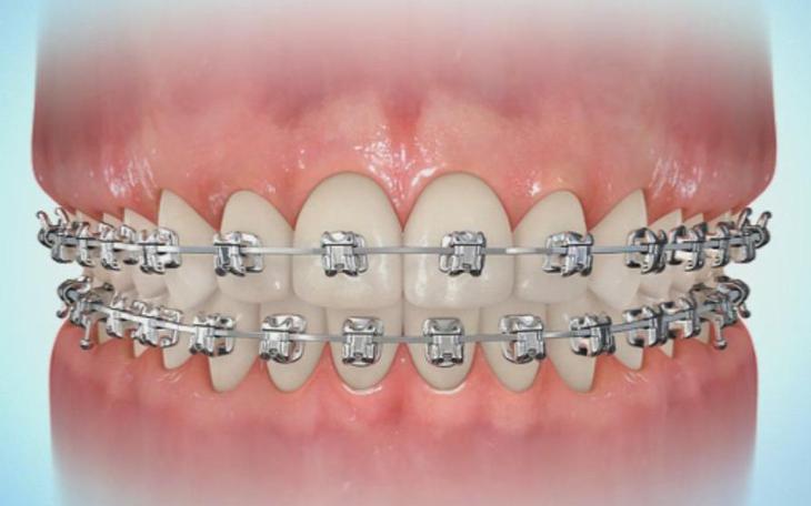 Giải Quyết Hiệu Quả Vấn Đề Hóp Má Khi Niềng Răng- Ảnh 1.