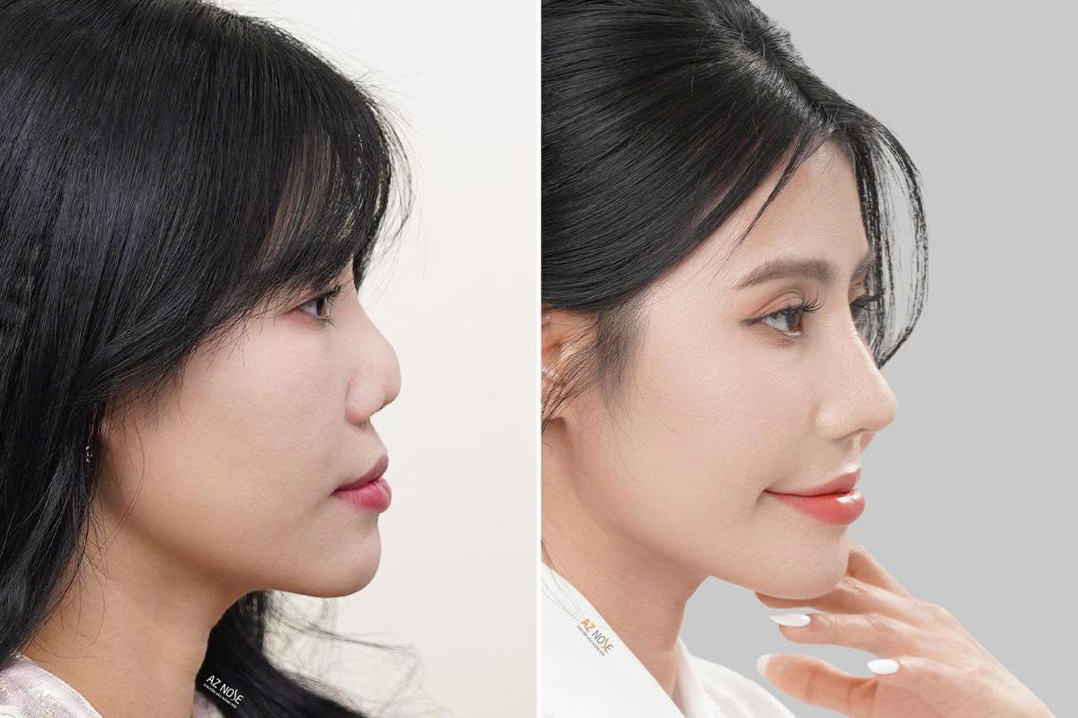 photo-1787887266659-1787887267344381302368 4 trường hợp thường được bác sĩ chỉ định nâng mũi cấu trúc- Ảnh 2.