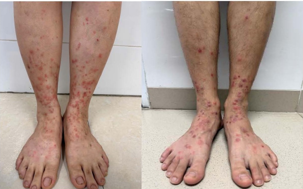 Xử Lý Nhanh Chóng Khi Có Nguy Cơ Viêm Da Tiếp Xúc