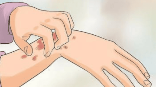 Giải Pháp Hiệu Quả Giảm Ngứa và Kiểm Soát Viêm Da Thần Kinh