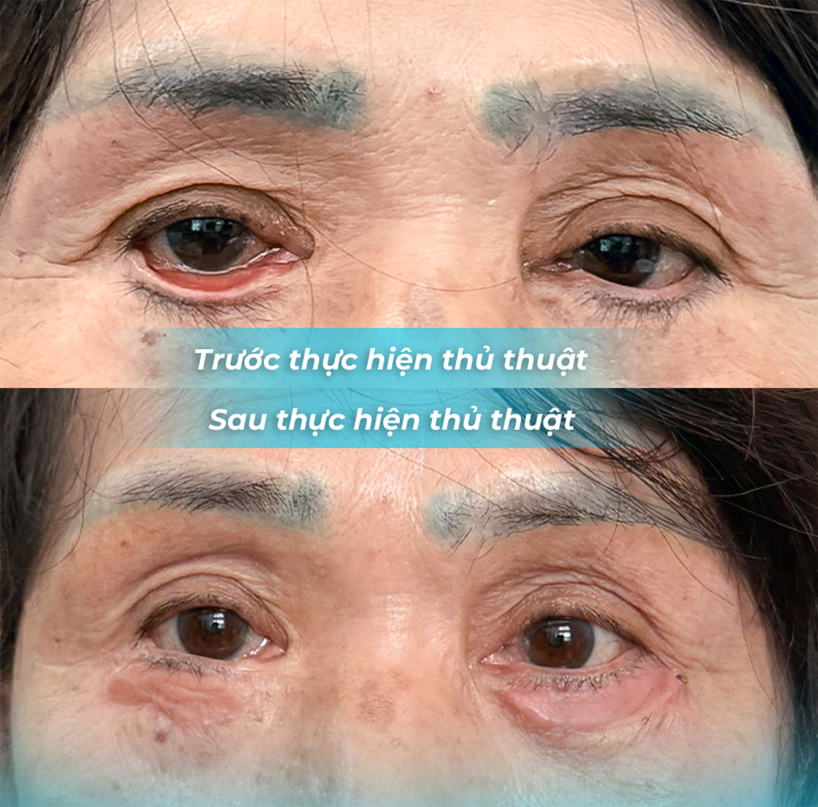 Tai Biến Sau Phẫu Thuật Thẩm Mỹ: Một Cảnh Báo Cần Thiết