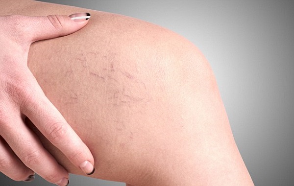 Biến Chứng Nguy Hiểm Từ Suy Giãn Tĩnh Mạch Chân: Nhận Diện và Điều Trị