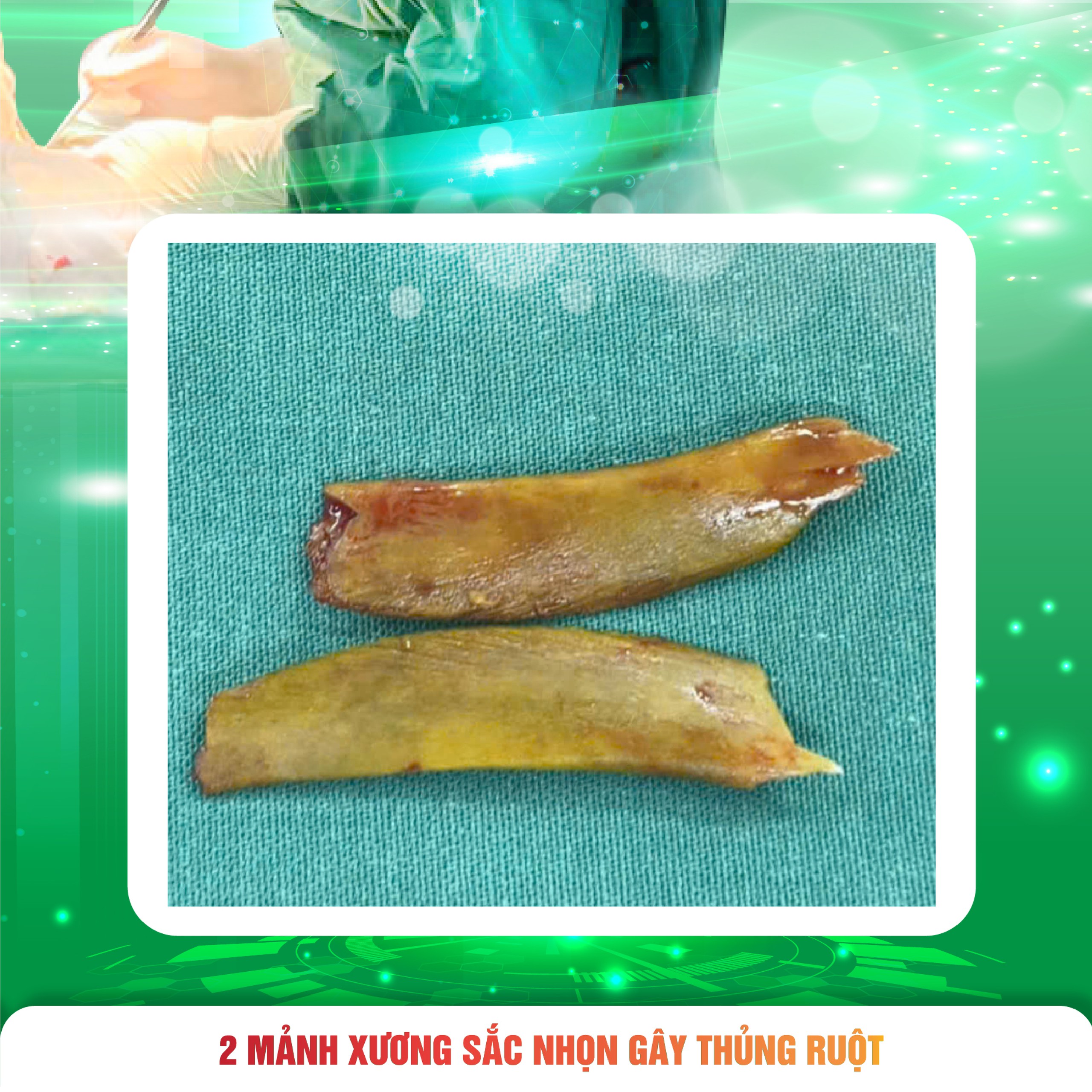 thung-ruot-2-lan-03-17856399131401884106549 Người đàn ông hai lần thủng ruột vì cùng một nguyên nhân- Ảnh 3.