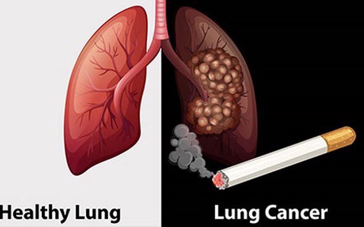 Chẩn Đoán Sớm Ung Thư Phổi: Giải Pháp Cứu Sống Nhiều Bệnh Nhân Tại Việt Nam