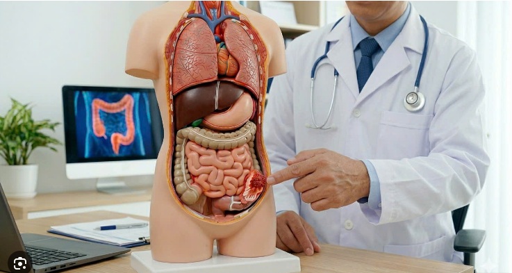 Nhận biết sớm ung thư đại tràng