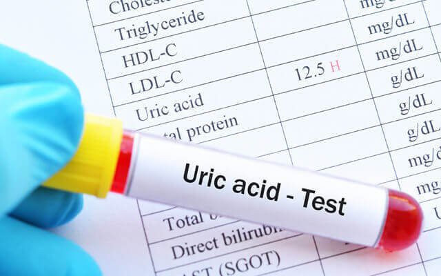 uric-acid-16983106537791692704412-0-0-400-640-crop-17577291099412035271772 Tìm Hiểu Điều Gì Xảy Ra Khi Uống Nước Chanh Mật Ong Hàng Ngày - Ảnh 3.