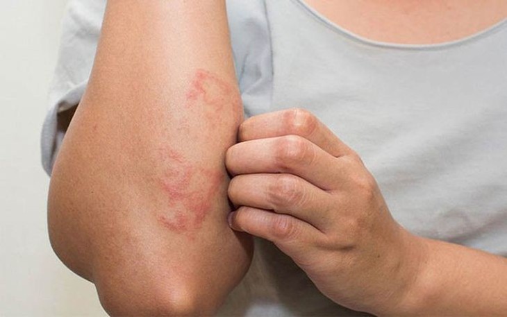 6 Chiến Lược Hiệu Quả Để Quản Lý Viêm Da Cơ Địa - Ảnh 1.