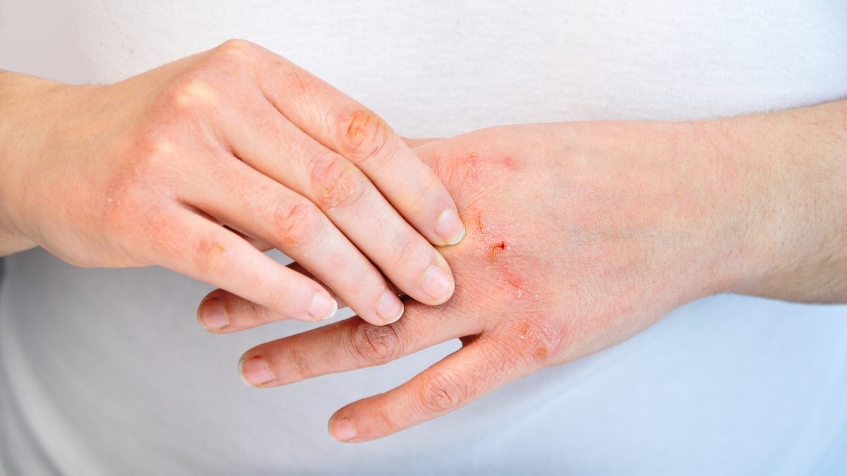 6 Chiến Lược Hiệu Quả Để Quản Lý Viêm Da Cơ Địa - Ảnh 2.