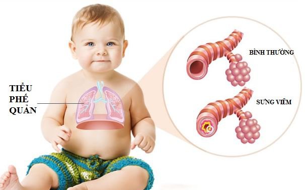 Hướng Dẫn Phát Hiện Sớm Viêm Tiểu Phế Quản Cấp Ở Trẻ Nhỏ