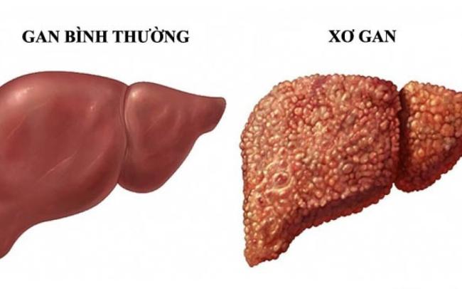 7 Dấu Hiệu Cảnh Báo Tổn Thương Gan Bạn Không Nên Bỏ Qua