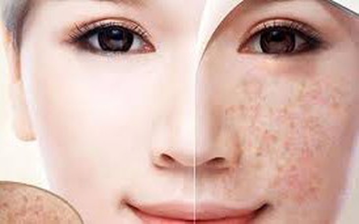 Giải Pháp An Toàn Để Đối Phó Với Đốm Đồi Mồi Trên Da - Ảnh 1.